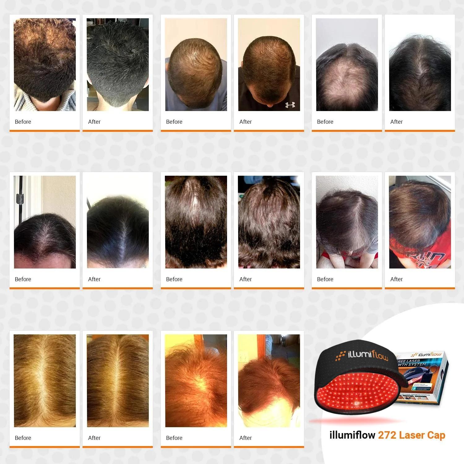 Diamond by illumiflow 272 LUX Laser Hair Growth System - Clinical Quality - Money-Back Guarantee - Image 3