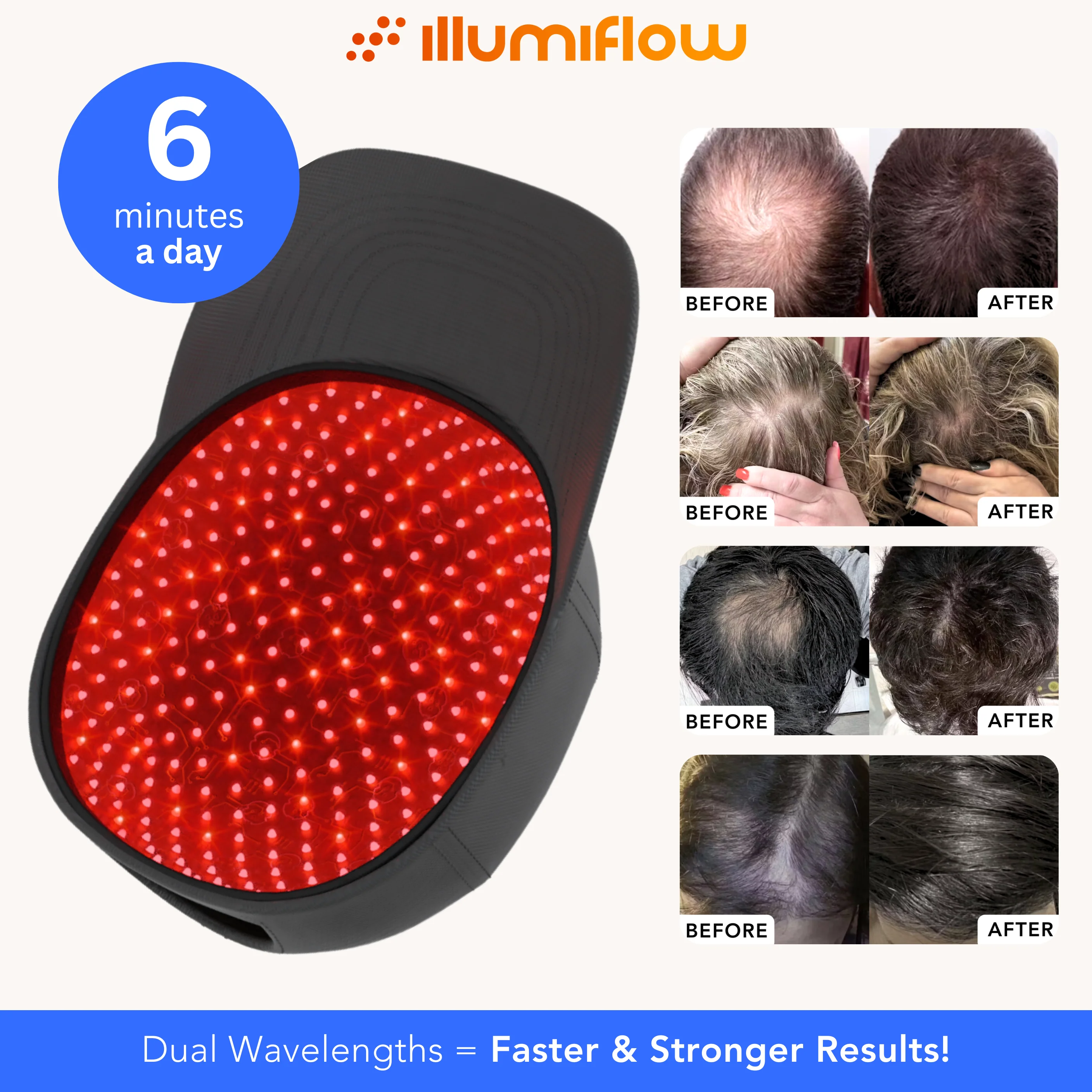 Illumiflow 312 Ultra – Dual Wavelength Flexible Laser Cap for Advanced Hair Growth - Image 3